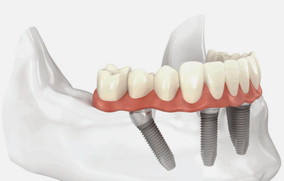 home-teeth-1 home-teeth-1