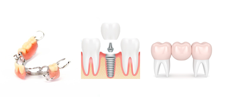 iSmile-replace-1 iSmile-replace-1