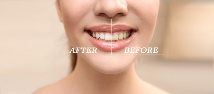 iSmile-teeth-whitening-queensland iSmile-teeth-whitening-queensland