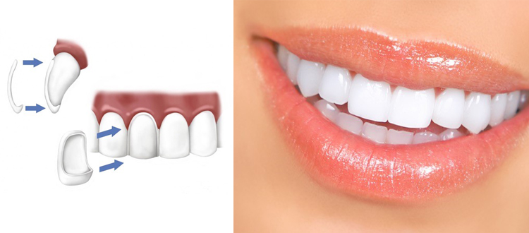 ismile-veneers ismile-veneers